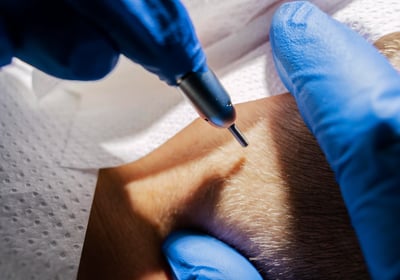 cabinet perma medical : trichopigmentation