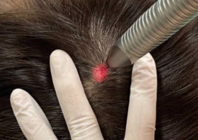 cabinet perma medical : laser