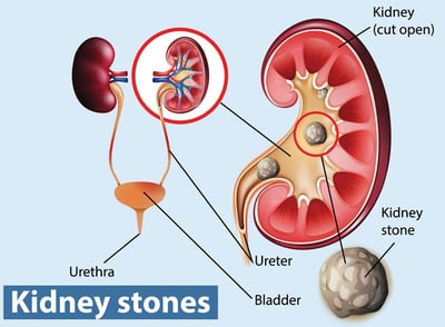 Kidney-Stones treatment near Kalaburagi, Karnataka, 