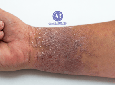 Eczema, Atopic Dermatitis