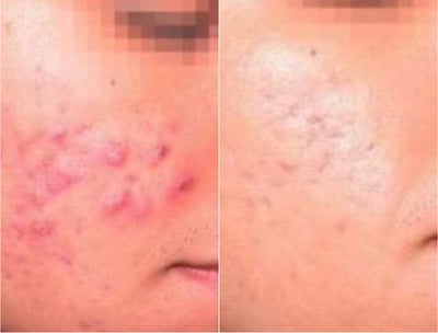 Resultado de tratamiento con láser para acné severo: mejora en textura y manchas