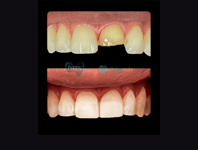 Rehabilitación oral