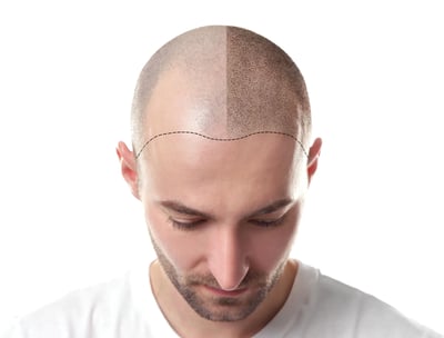 hair transplant-saç ekim