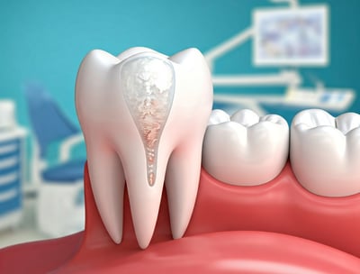 Invisible Fillings in Dentistry kool smiles