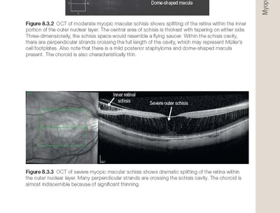 OCT com edema macular