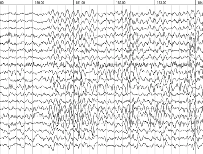 EEG-Lake-Mary-Neurologist