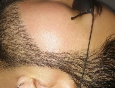Resultados de depilación láser facial en hombre con barba: reducción visible del vello