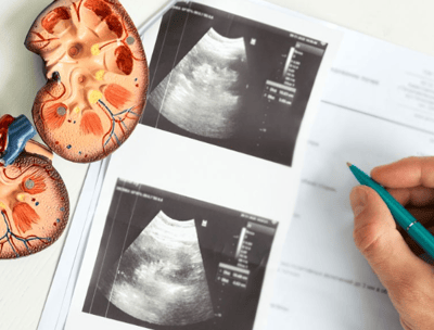 diabetic kidney disease screening