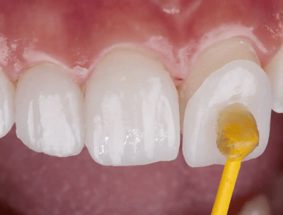 Faccette dentali, denti bianchi