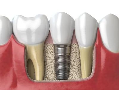 Impianto dentale dente