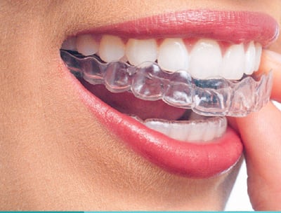 Mascherine invisibili, Invisalign, Clear Correct