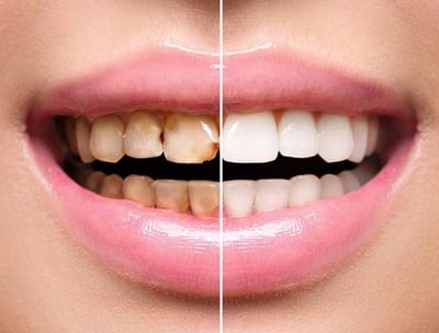 a woman's teeth whitening and a smile