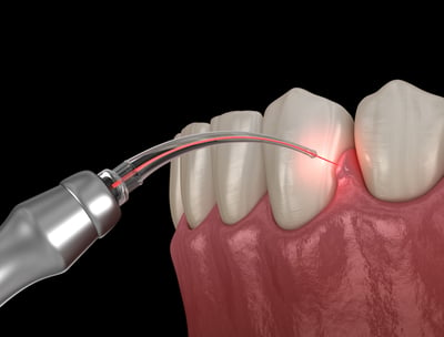 a dental device with a dental device attached to it