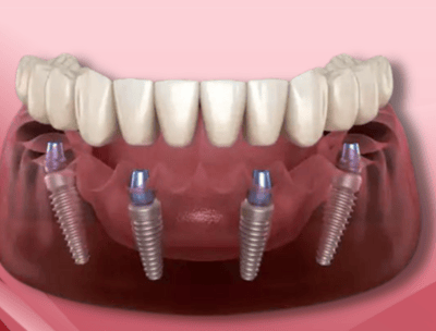 a dental implanting implanting teeth and implants