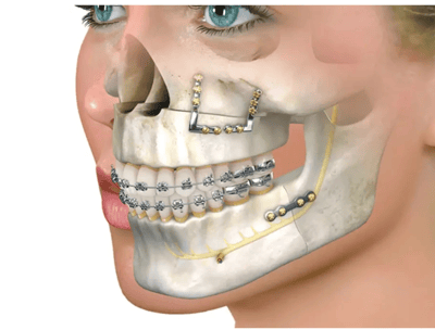 a woman with braces and braces on her teeth