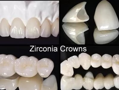 a series of dental crowns with teeth and teeth