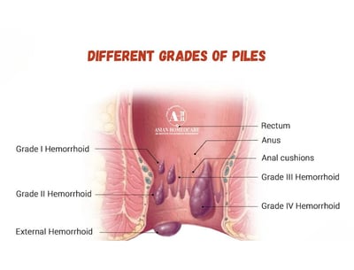 Types of piles and grade of piles - Asian Homeocare