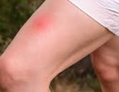 Complete Guide to Bee Stings  Treatment option , 