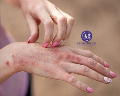 Contact Dermatitis