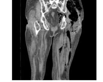 Necrotizing Fasciitis Flesh-Eating disease