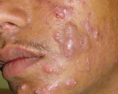 Doença inflamatória que envolve as glândulas sebáceas (que produzem oleosidade)