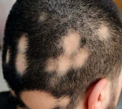 Queda de cabelo em áreas, ou queda completa dos cabelos e pelos do corpo