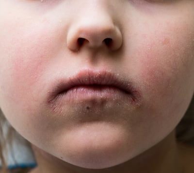 doença que provoca manchas avermelhadas e ressecadas no corpo, que coçam muito.
