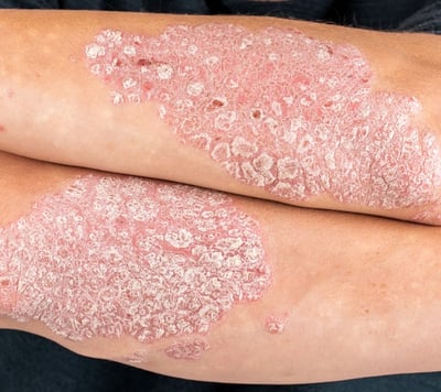 uma pessoa com psoríase, manchas avermelhadas cobertas de escamas esbranquiçadas que coçam