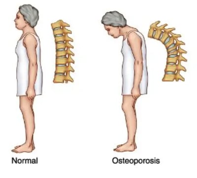 Get Osteoporosis Treatment From Dr.Shalini in Hyderabad