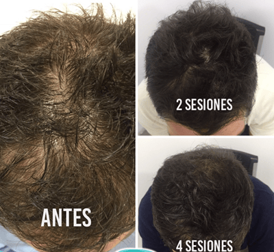 Mesoterapia para la caida del cabello 