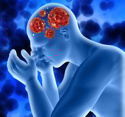 Demyelinating Diseases