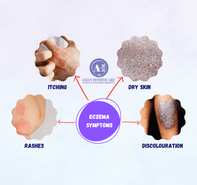 Eczema Symptoms