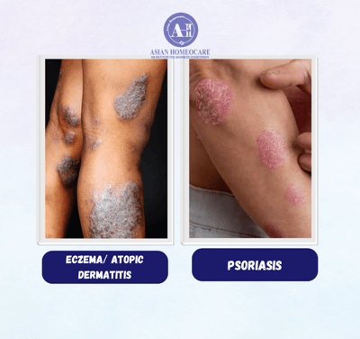 Eczema vs Psoriasis