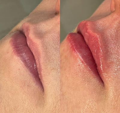 Preenchimento labial natural, sem exageros. Tecnica lipkiss