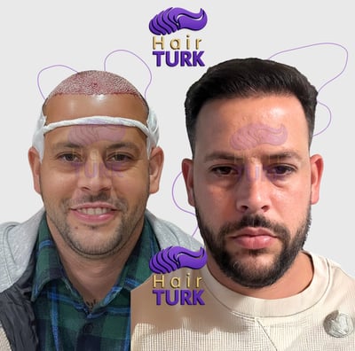Before & after FUE hair transplant at HairTurk: Full bald man to full hair, smiling.