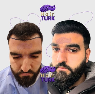 Before & after DHI hair transplant at HairTurk: bald man to full hair, smiling