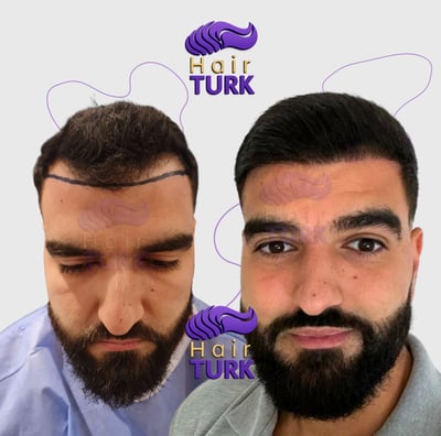 Before & after FUE hair transplant at HairTurk: Full bald man to full hair, smiling.