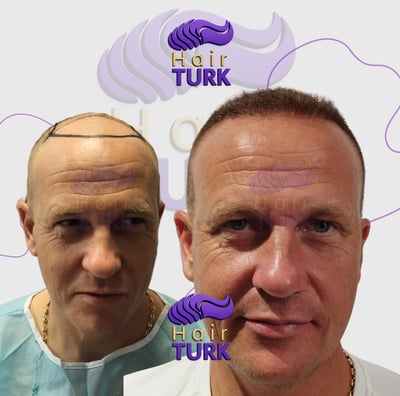 Before & after FUE hair transplant at HairTurk: Full bald man to full hair, smiling.