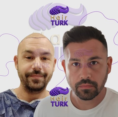 Before & after FUE hair transplant at HairTurk: bald man to full hair, smiling