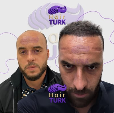 Before & after FUE hair transplant at HairTurk: Full bald man to full hair, smiling.