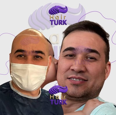 Before & after FUE hair transplant at HairTurk: Full bald man to full hair, smiling.