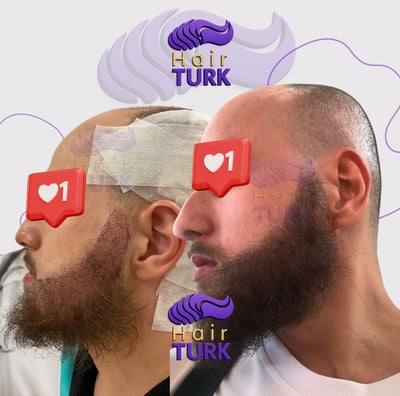 Before & after DHI beard transplant at HairTurk: bald man to full beard, smiling