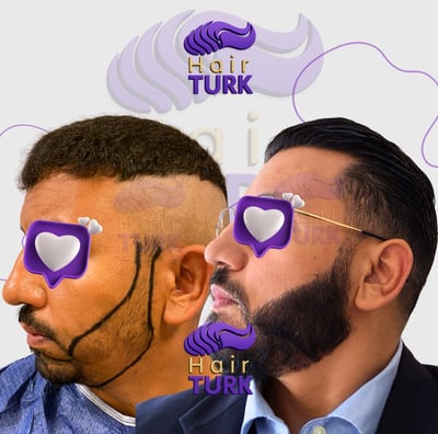 Before & after FUE beard transplant at HairTurk: bald man to full beard.