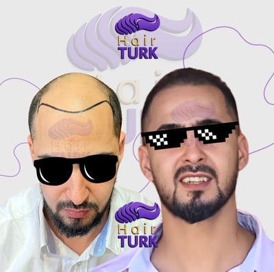 Before & after FUE hair transplant at HairTurk: Full bald man to full hair, smiling.