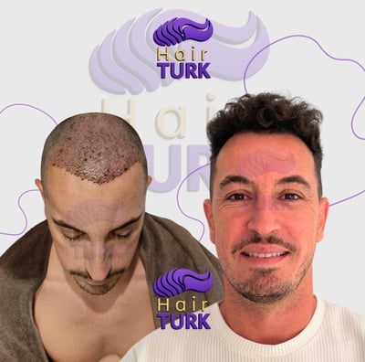 Before & after FUE hair transplant at HairTurk: bald man to full hair, smiling