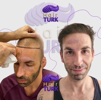 Before & after hair transplant at HairTurk: bald man to full hair, smiling