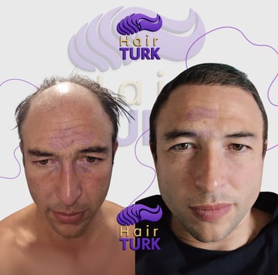 Before & after hair transplant at HairTurk: full bald man to full hair.