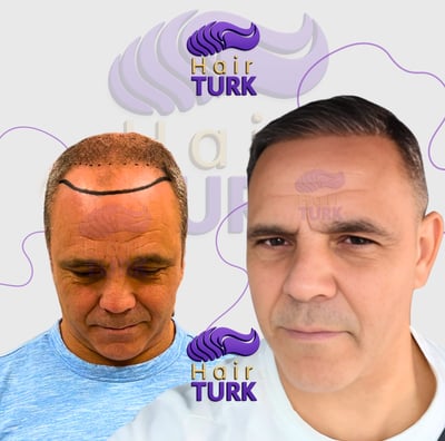 Before & after FUE hair transplant at HairTurk: Full bald man to full hair, smiling.