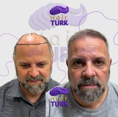 Before & after hair transplant at HairTurk: elderly bald man to full hair, smiling