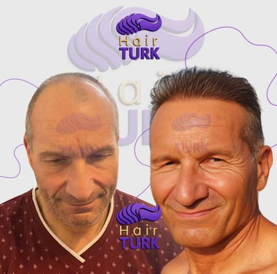 Before & after hair transplant at HairTurk: elderly bald man to full hair, smiling